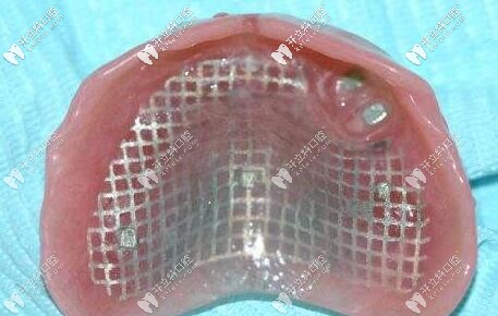 膠托鑄網(wǎng)活動義齒