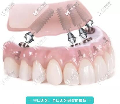 拔牙后能立即種牙嗎?北京做種植牙好的這家口腔說出了真相