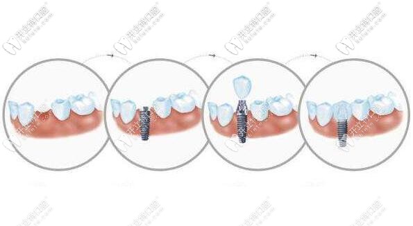 上海連鎖口腔復(fù)工了~韓國neo種植體包干價(jià)格很實(shí)在！