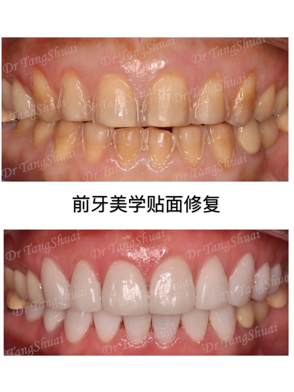 北京雅醫(yī)家口腔用我親身做貼面的感受給大家談?wù)勓例X貼面的優(yōu)缺點