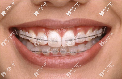 陶瓷半隱形托槽矯正