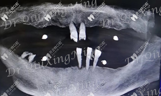 大爺口腔CT照 大爺口腔CT照