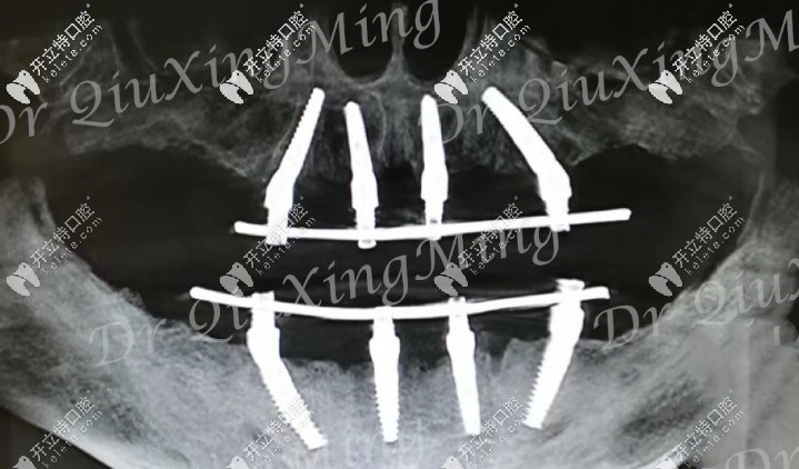 all-on-4全口種植牙技術(shù) all-on-4全口種植牙技術(shù)