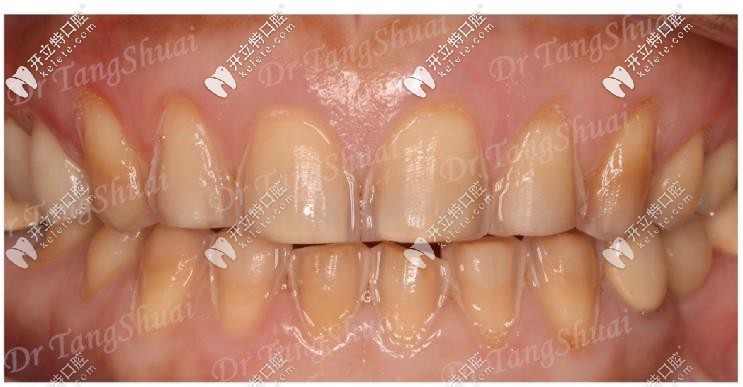 做牙齒貼面前牙齒狀態(tài)