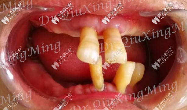大爺口腔剩余牙齒圖 大爺口腔剩余牙齒圖