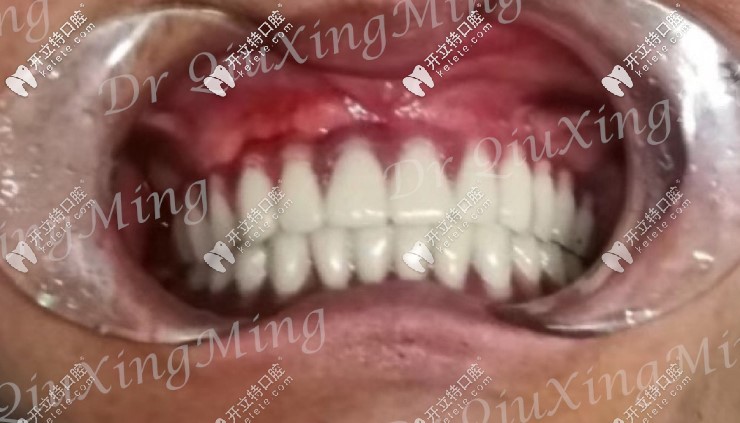 全口種植牙效果圖 全口種植牙效果圖