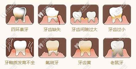 適合做牙齒貼面的牙齒情況