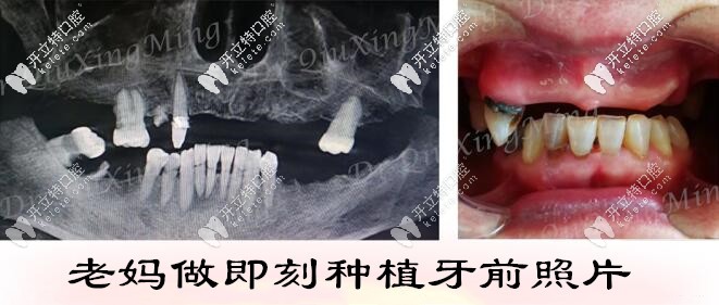 老媽在北京雅醫(yī)家口腔做種植牙前