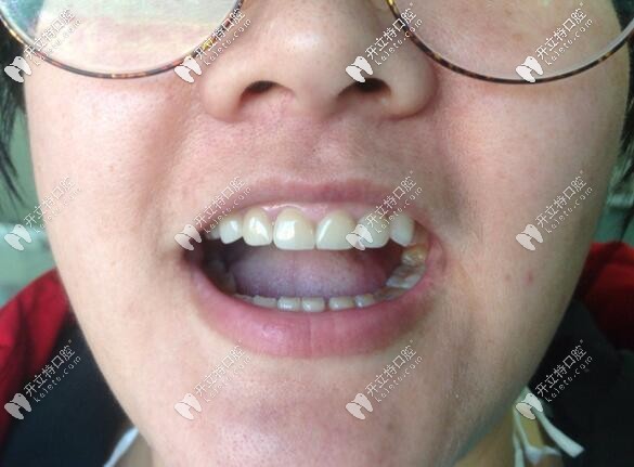 唐山誠品口腔牙貼面真人案例