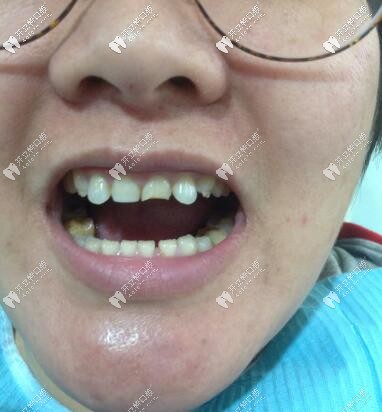 門牙磕斷了必須根管治療嗎?她還做了瓷貼面呢，超贊