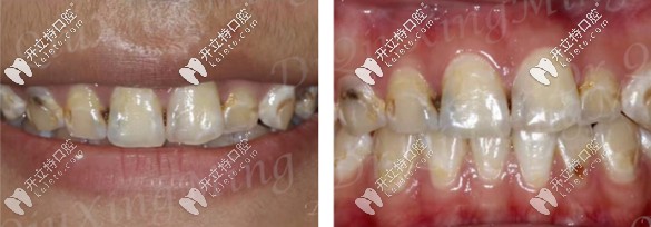 牙齒貼面修復前的口內(nèi)照