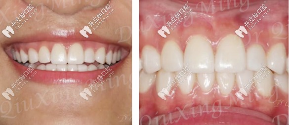 全瓷貼面修復效果圖