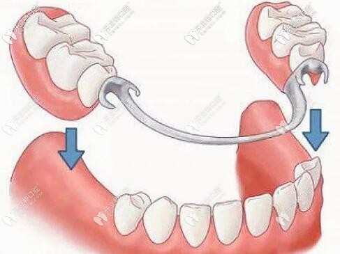 哇！在廣州戴過的掛鉤活動假牙可以換購進(jìn)口種植牙啦！