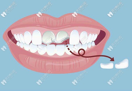 江湖救急!請(qǐng)問門牙斷了一半做補(bǔ)牙的價(jià)格是多少啊