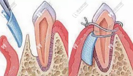 GBR膜引導(dǎo)骨組織再生術(shù)