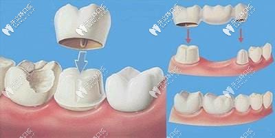 牙冠修復(fù)