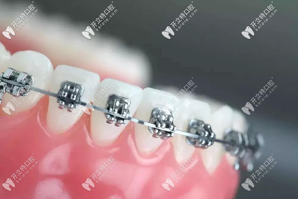 自鎖金屬托槽矯正