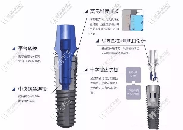 國產威高種植體介紹