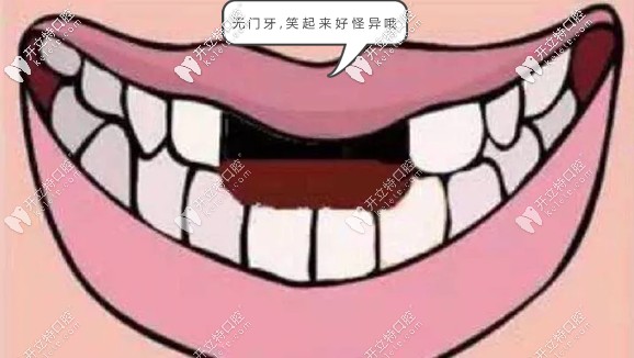 門牙為什么要選即拔即種?可借鑒我的門牙種植經(jīng)歷哈