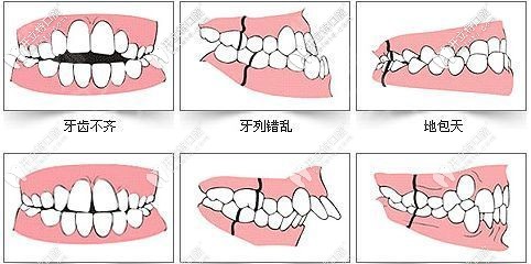 六種情況你要矯正牙齒