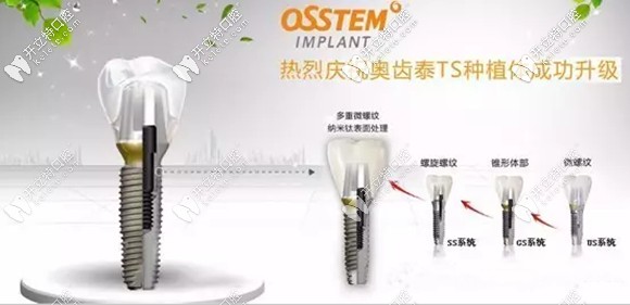 韓國奧齒泰種植體5800元一顆