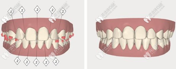 隱形矯正讓你提前看到矯正效果圖