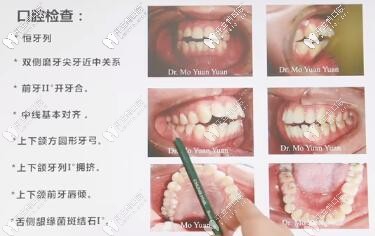 骨性前凸開頜,拔牙四顆,進(jìn)口ormco自鎖托槽矯正,歷時(shí)22個(gè)月