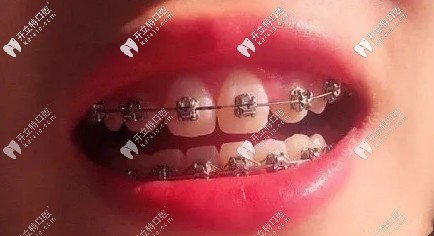 牙齒已經(jīng)排齊了該戴橡皮筋啦