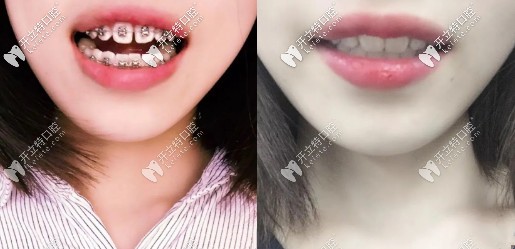 整牙前后對(duì)比照有種知性美