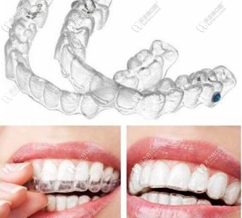 無托槽隱形矯正