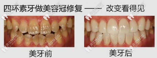 沈陽百嘉麗口腔四環(huán)素牙做美容冠效果