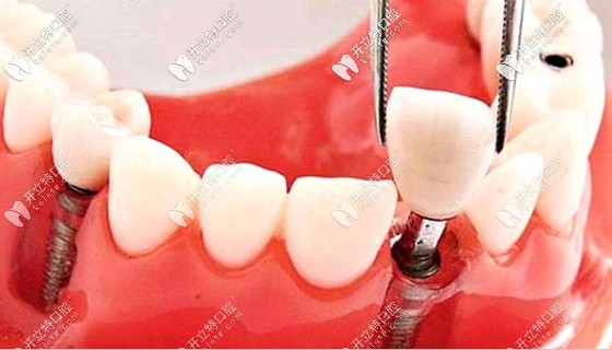 李紹軍醫(yī)師是瑞典NOBEL公司特聘種植醫(yī)師