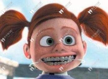 被價格勸退,中意時代天使,卻選擇了博思美隱形矯正+片切