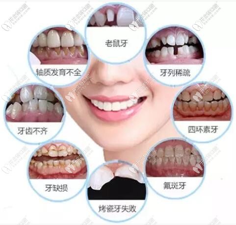 經(jīng)歷2次修復(fù),說(shuō)說(shuō)做完瓷貼面的真實(shí)感受,有后悔,也有驚喜