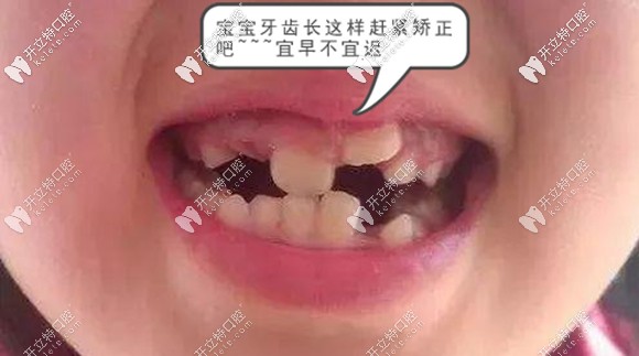 孩子牙齒錯頜不齊真人效果圖
