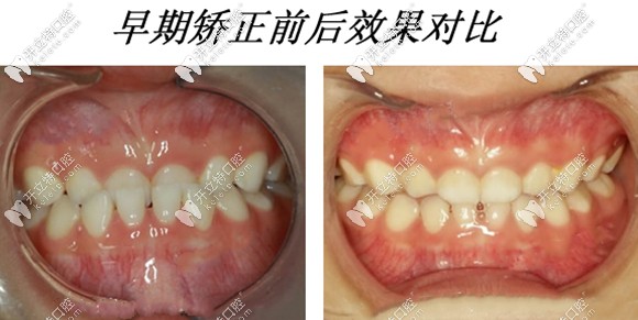 早期干預(yù)矯正的效果圖對比