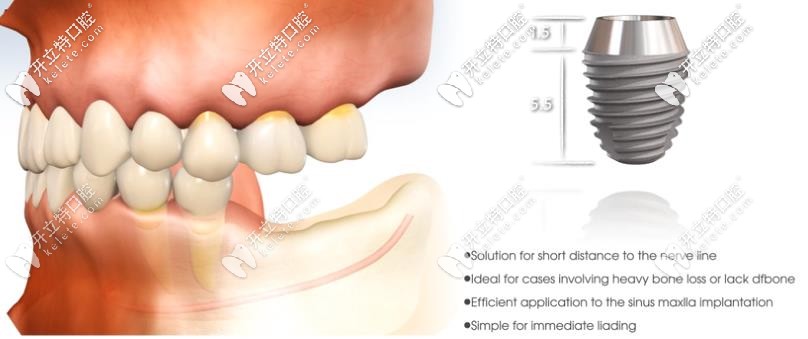 登騰SuperLine短種植體