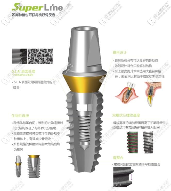 登騰superline種植體型號