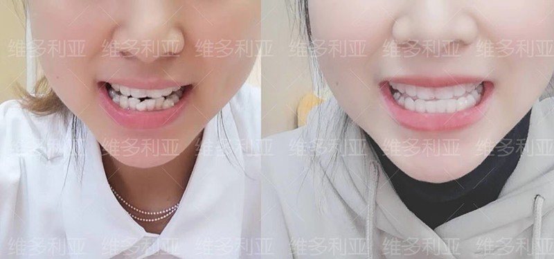 門(mén)牙外翻在杭州做隱適美隱形矯正已10個(gè)月,效果肉眼看可見(jiàn)