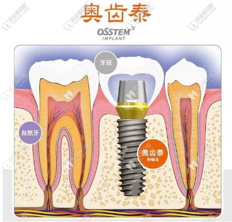 韓國奧齒泰種植體