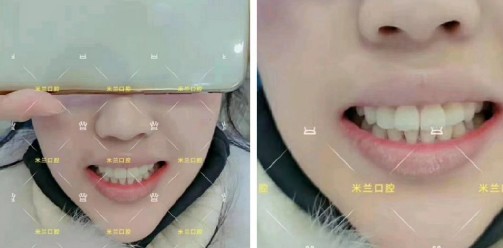 直到多生牙把門牙都擠變形了，才決定拔牙帶3M自鎖牙套矯正