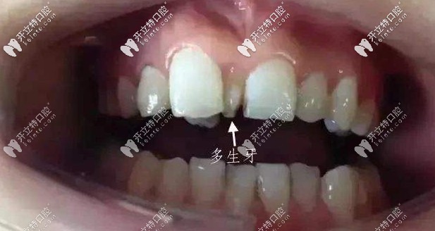 遺傳性多生牙把門牙擠變形了