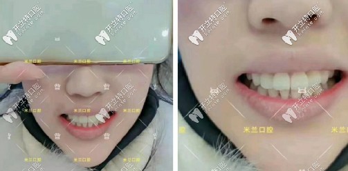 門牙中間多生牙矯正效果圖