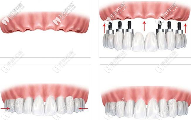 分享老爸做All on 6半口種植牙的效果圖,原來all on six技術(shù)好贊