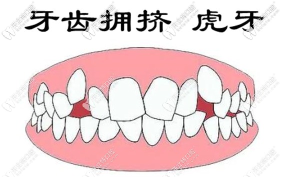 虎牙矯正可以用透明牙套嗎