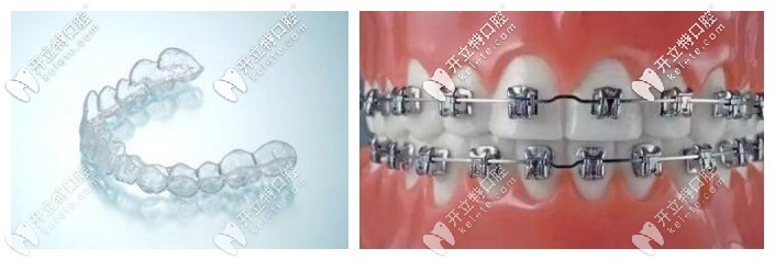 隱形牙套和金屬牙套對比圖示
