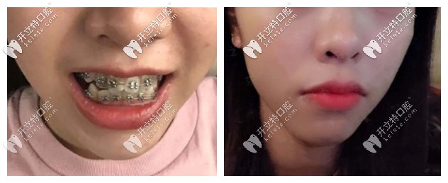 牙齒擁擠不齊導(dǎo)致嘴凸