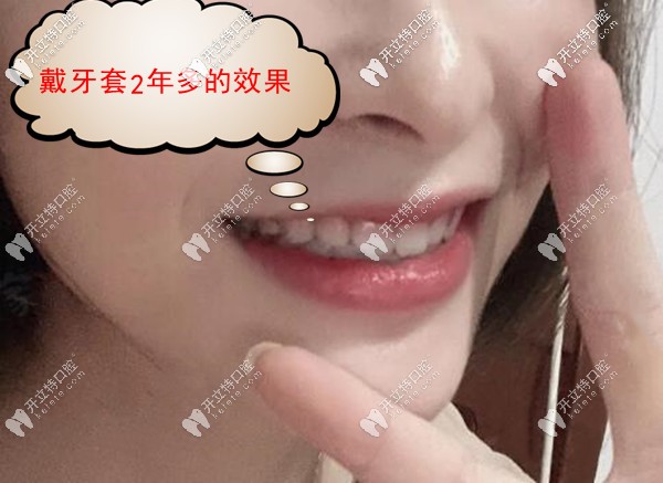 齙牙加露齦笑戴牙套矯正效果