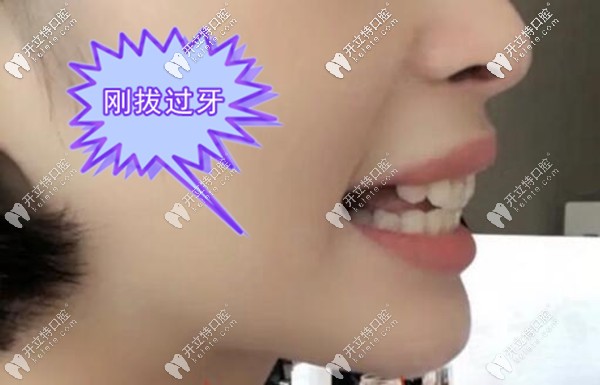 骨性齙牙加露齦笑矯正前先拔牙