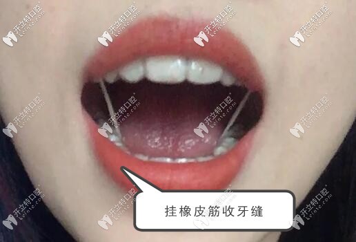 虎牙戴隱形牙套2年的效果